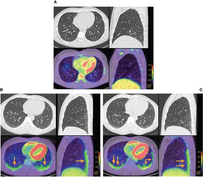 Frontiers | Positron Emission Tomography To Improve Assessment Of ...